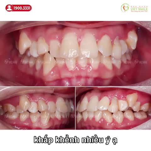 Chắc hẳn nhiều người đã từng nghe nói niềng răng trong khoảng từ 6 - 12 tuổi là độ tuổi đẹp nhất để niềng răng.