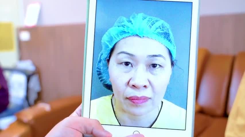 Combo trẻ hóa mí mắt toàn diện Cắt mí + Nâng cung mày vừa thực hiện xong cho cả nhà cùng chiêm ngưỡng