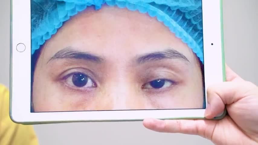 Dr.Hải Lê giải cứu mọi ca mí sụp bẩm sinh/ mí lỗi hỏng ở đâu từ chối chúng tôi nhận và mang đến cho bạn sự tự tin như mong đợi