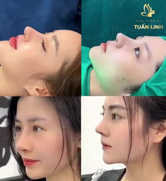 Rẻ mà đẹp, đẹp mà bền chính là nâng mũi bọc sụn tai.