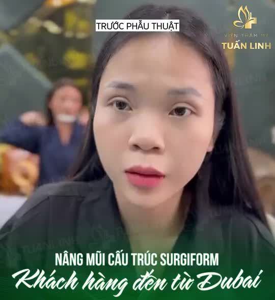 Nâng mũi cấu trúc Surgiform và 90 phút thay đổi hương mặt mhuw thế nào?