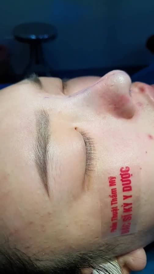 Giải cứu mũi đã từng nâng tại Spa ở Buôn Ma Thuột.