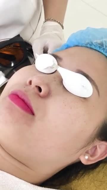 Xóa sạch tàn nhang chỉ với 499k - Chớp ngay ưu đãi thôi cả nhà ơi