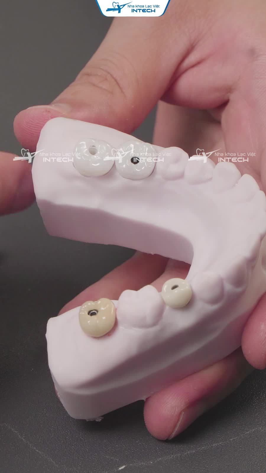 Các dạng phục hình răng sứ trên Implant.