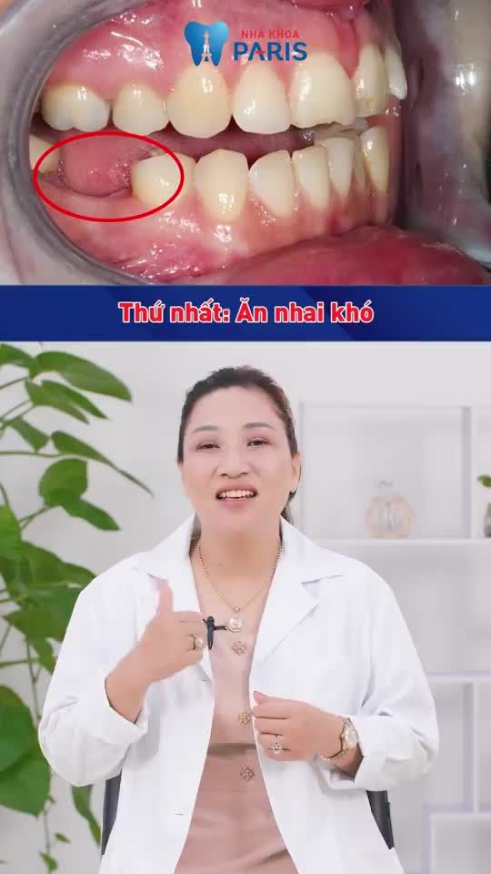 Vì sao mất răng nên trồng lại răng sớm?
