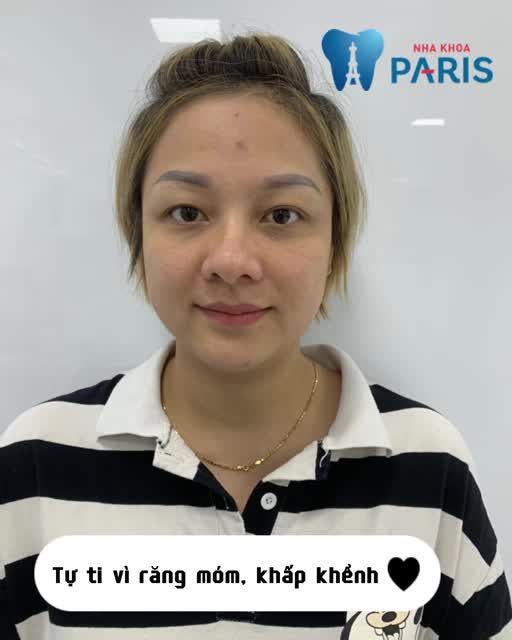 Nhớ lắm cô gái năm ấy Móm, Khấp Khểnh Vì “Niềng Răng” mà trở nên “Xinh Đẹp”