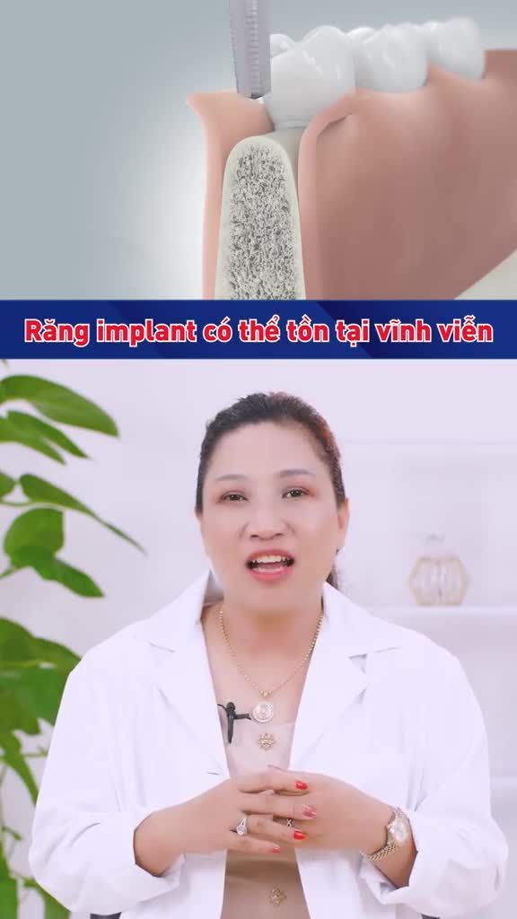 TALK CÙNG CHUYÊN GIA 56: RĂNG TRÊN IMPLANT CÓ THỂ TỒN TẠI VĨNH VIỄN KHÔNG?