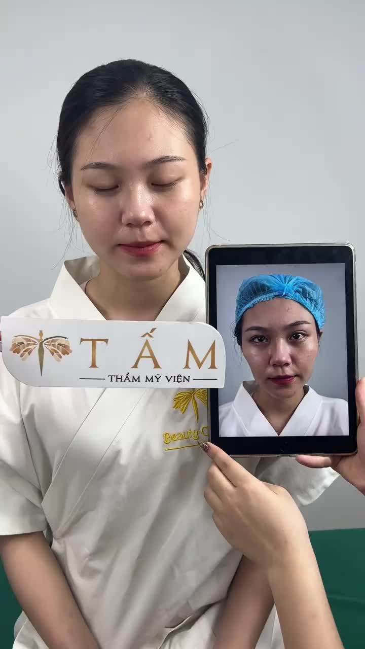 Khác biệt hoàn toàn ngay sau khi thực hiện filler má của bạn khách hàng tại phòng khám TMV Tấm.