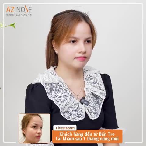 Khách hàng đến từ Bến Tre tái khám sau 1 tháng nâng mũi cấu trúc - thực hiện bởi bác sĩ CKI. Đinh Xuân Sơn Tùng.