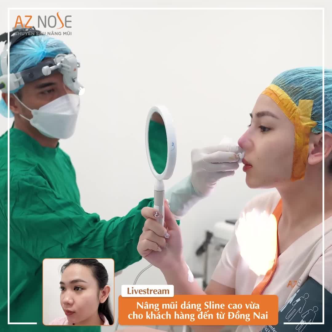 Nâng mũi cấu trúc, dáng Sline cao, đầu mũi tròn cho khách hàng 9X đến từ Đồng Nai