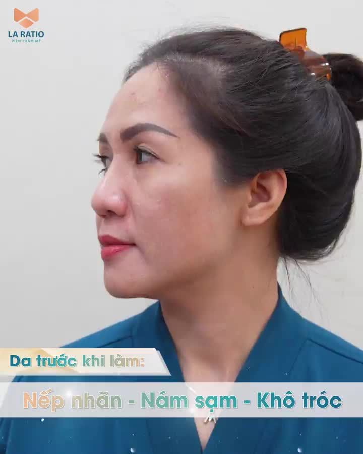 PICO TONING - BÍ QUYẾT TÁI SINH TRẺ HÓA LÀN DA HIỆU QUẢ NHANH - AN TOÀN TUYỆT ĐỐI