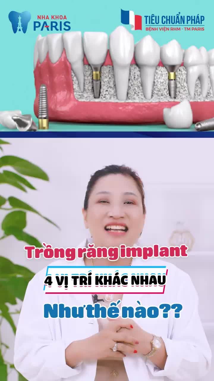 TRỒNG RĂNG TẠI CÁC VỊ TRÍ KHÁC NHAU NHƯ THẾ NÀO?