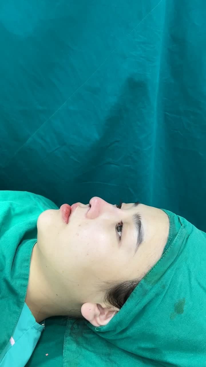 Case mũi sửa lại vừa hoàn thành
