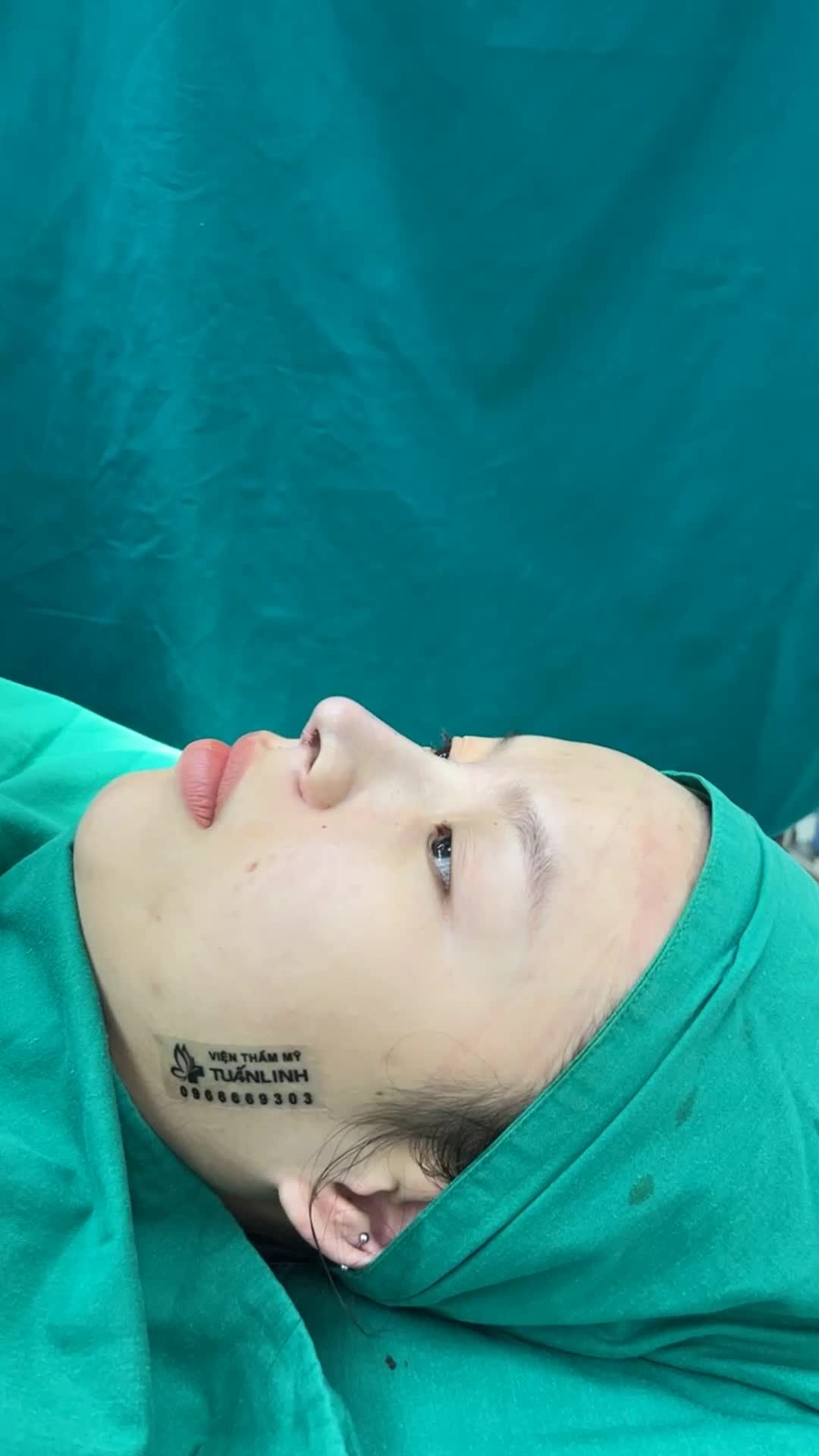 Case mũi cấu trúc vừa hoàn thành
