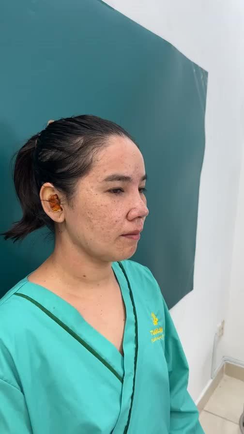 HOÀN THÀNH case Nâng mũi cấu trúc cho bạn Khách hàng may mắn trúng giải bốc thăm tài trợ 100% ngày 30/5/2023.