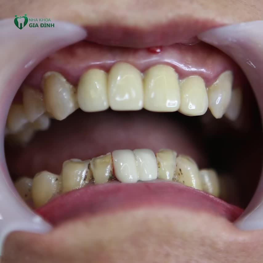 LẦN THỨ BA, TÔI QUYẾT ĐỊNH CHỌN NHA KHOA GIA ĐÌNH THẨM MỸ RĂNG SỨ