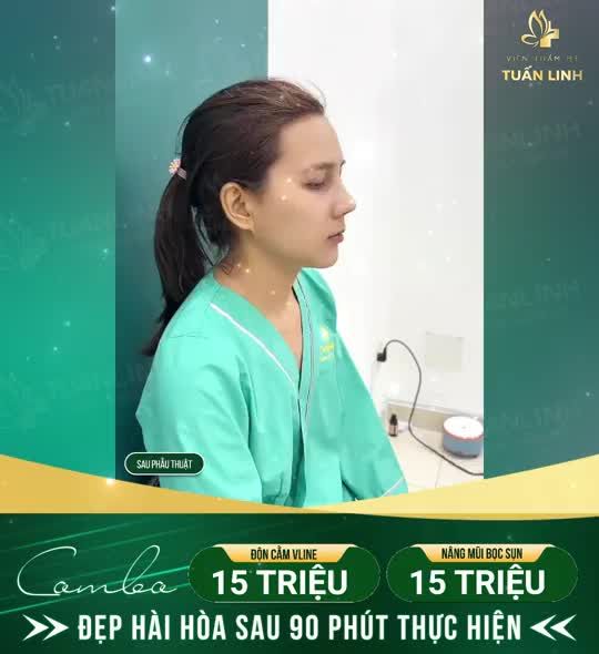 Combo Nâng mũi bọc sụn + Độn cằm Vline => Giúp gương mặt đẹp sang, sắc nét!!