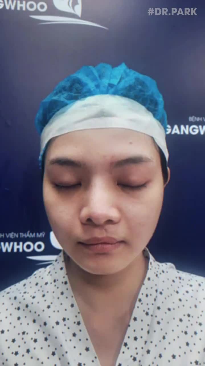 CẮT MÍ EYELID MANG LẠI CHO BẠN ĐIỀU GÌ?