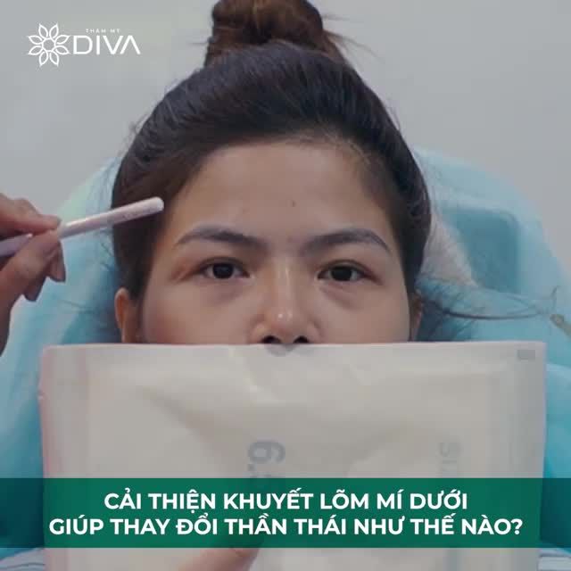 KHUYẾT LÕM VÀ TÚI MỠ MẮT DƯỚI ẢNH HƯỞNG ĐẾN THẦN THÁI RA SAO?