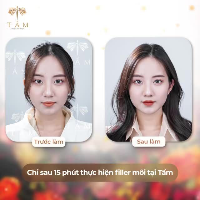 Bạn muốn sở hữu đôi môi đầy đặn, gợi cảm và quyến rũ mà không cần phẫu thuật? Filler môi tại Tấm chính là giải pháp dành cho bạn.