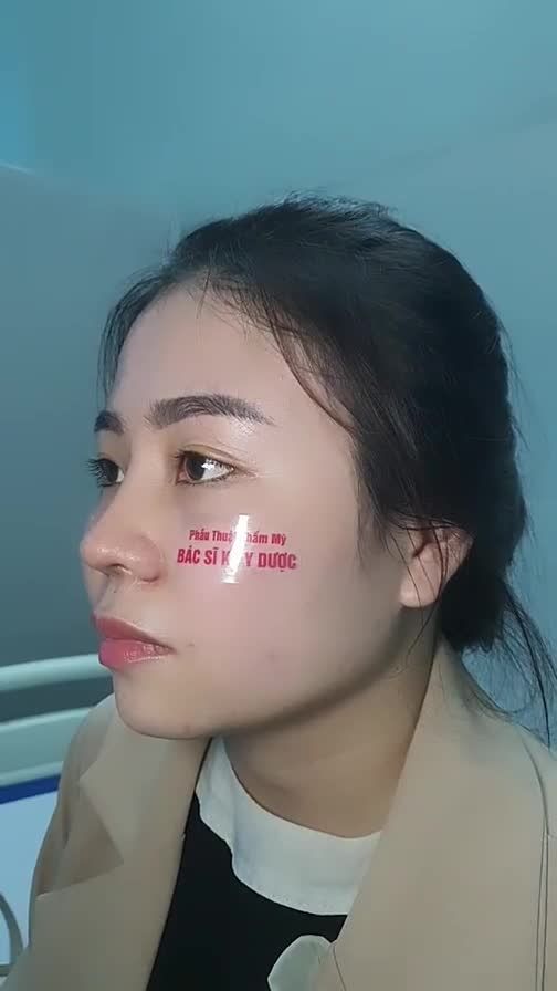 Kết qua sau 1 tháng thực hiện dịch vụ Nâng mũi ALINE bán cấu trúc đa lớp kết hợp thu cánh mũi sẽ như thế nào?