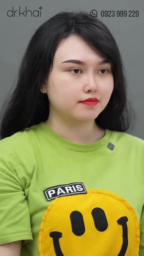 TÁI KHÁM SAU HƠN 1 THÁNG NÂNG MŨI CẤU TRÚC DÁNG MŨI BỀN ĐẸP THEO THỜI GIAN