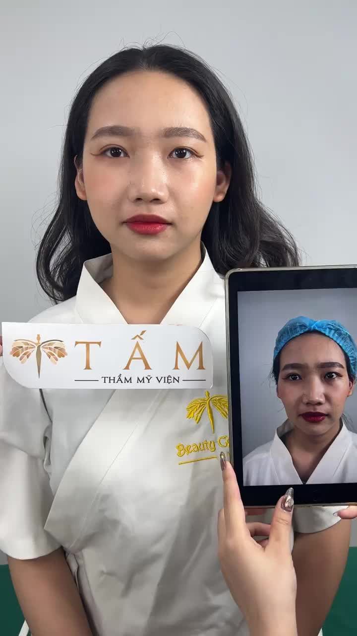 Cận cảnh ca cân chỉnh má, thái dương tại phòng khám TMV Tấm.