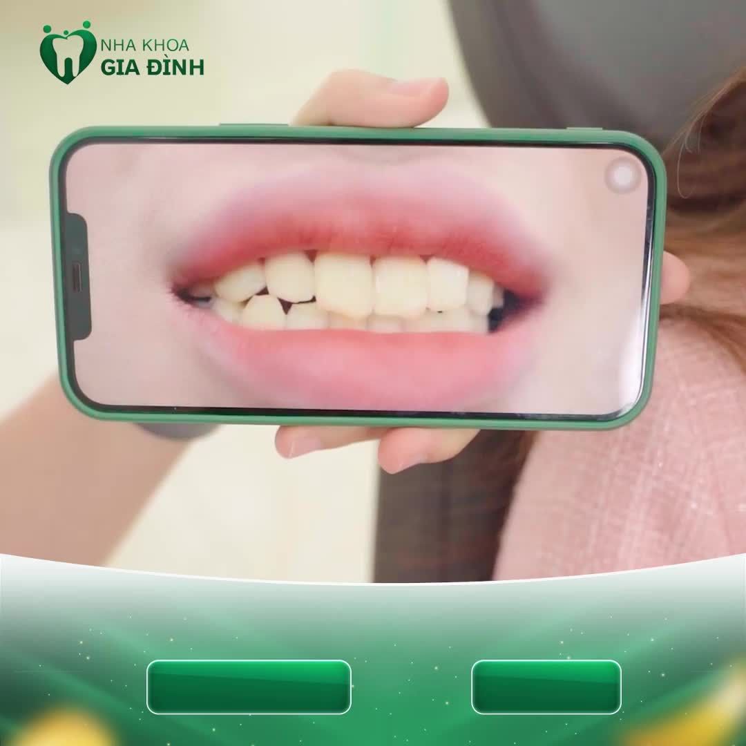KHẮC PHỤC TÌNH TRẠNG RĂNG Ố VÀNG, HÌNH THỂ XẤU... SAU 2 LẦN HẸN