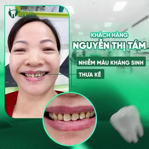 SO VỚI HÀM RĂNG CŨ TRƯỚC KIA THÌ HÀM RĂNG MỚI PHẢI 10/10"