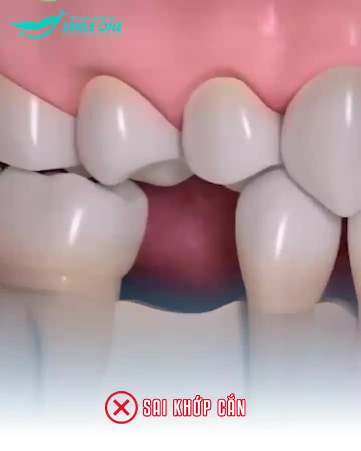 Mất răng có thể gây ra rất nhiều các vấn đề nghiêm trọng