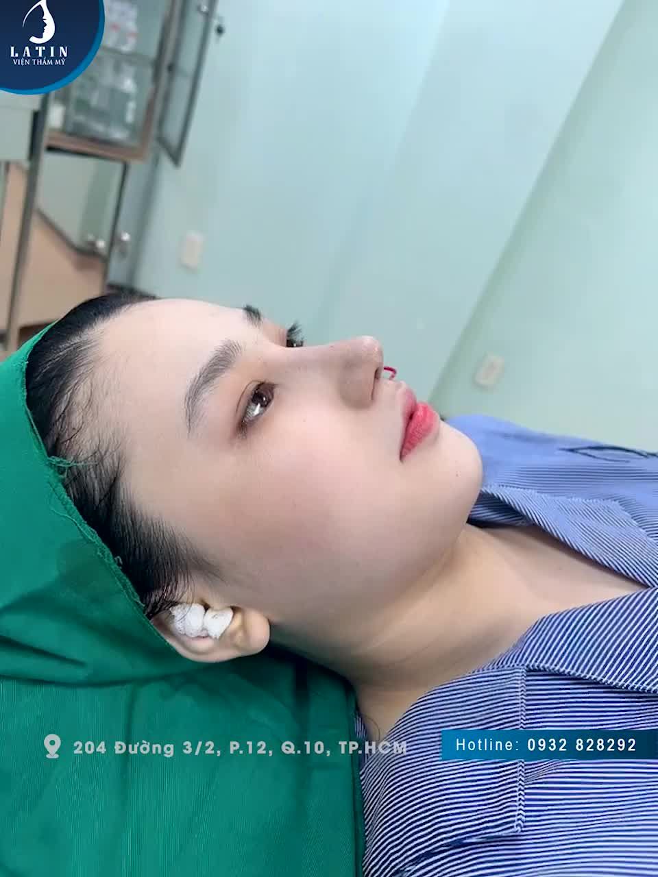 Mũi cấu trúc vừa hoàn thành cho em gái đến từ Long An