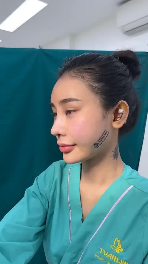Case mũi Tái cấu trúc vừa hoàn thành
