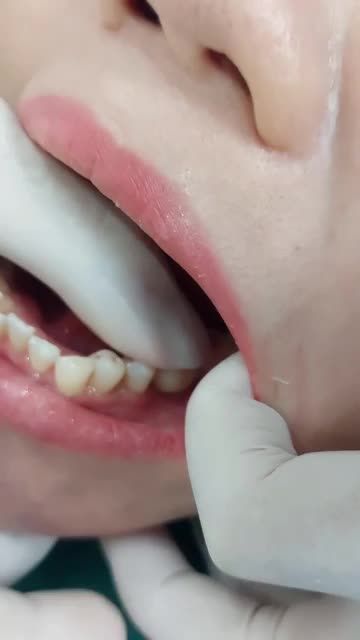 Lắp răng trên implant  Nha Kkhoa Yteeth