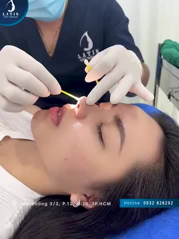 NÂNG MŨI CẤU TRÚC LATIN - HÓA HOT GIRL CHỈ SAU 10 NGÀY