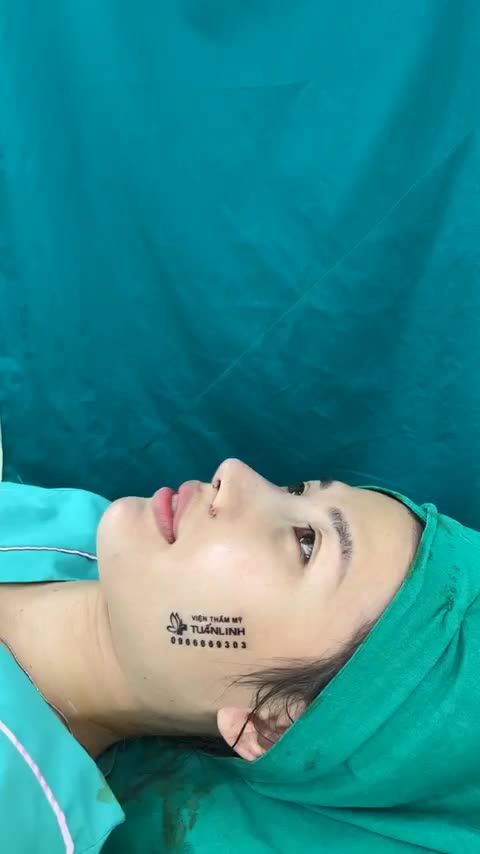 Case combo mũi cằm vừa hoàn thành