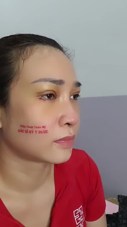 COMBO NÂNG MŨI + CẮT MÍ SAU 7 NGÀY