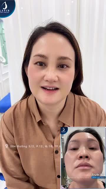 Khách hàng Việt kiều tái khám và cắt chỉ sau 10 ngày nâng mũi cấu trúc