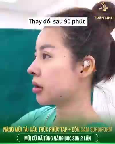 Phương pháp: Nâng mũi tái cấu trúc + độn cằm Surgiorm  Cho gương mặt cân đối, đẹp hài hòa.