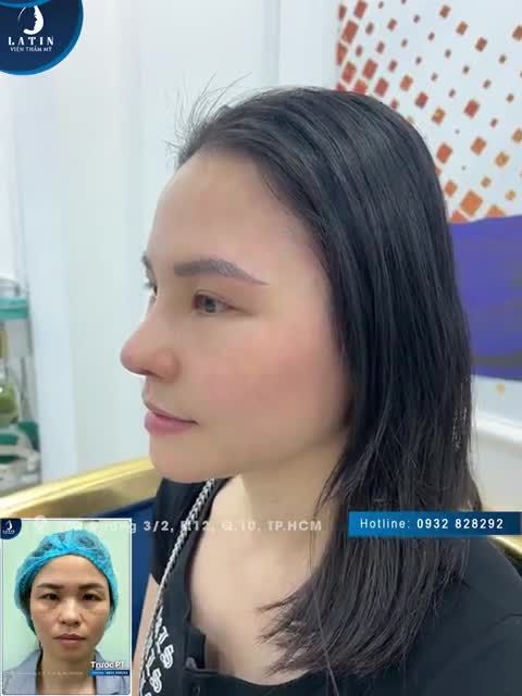 "Chị rất là hài lòng" - Lời chia sẻ của chị gái Việt kiều Anh sau 10 ngày làm đẹp tại Latin