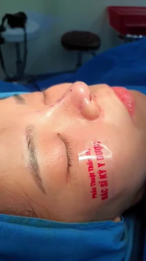 Vẫn là cô gái ấy, nhưng giờ đã xinh hơn rất nhiều nhờ vào Nâng mũi Aline bán cấu trúc 2 lớp tại Bác sĩ Kỳ Y Dược.