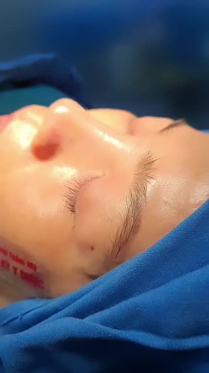 Nâng mũi ALINE chuẩn tỷ lệ vàng -  Tương thích hoàn hảo - An toàn tuyệt đối!