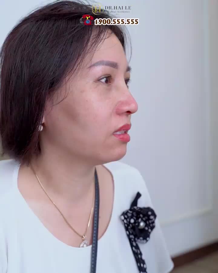 Dáng mũi cũ của vị khách hàng với sống mũi thấp, cánh mũi xệ được "nâng cấp" thành dáng mũi cao bay tự nhiên, mềm mại, hài hòa với tổng thể gương mặt!