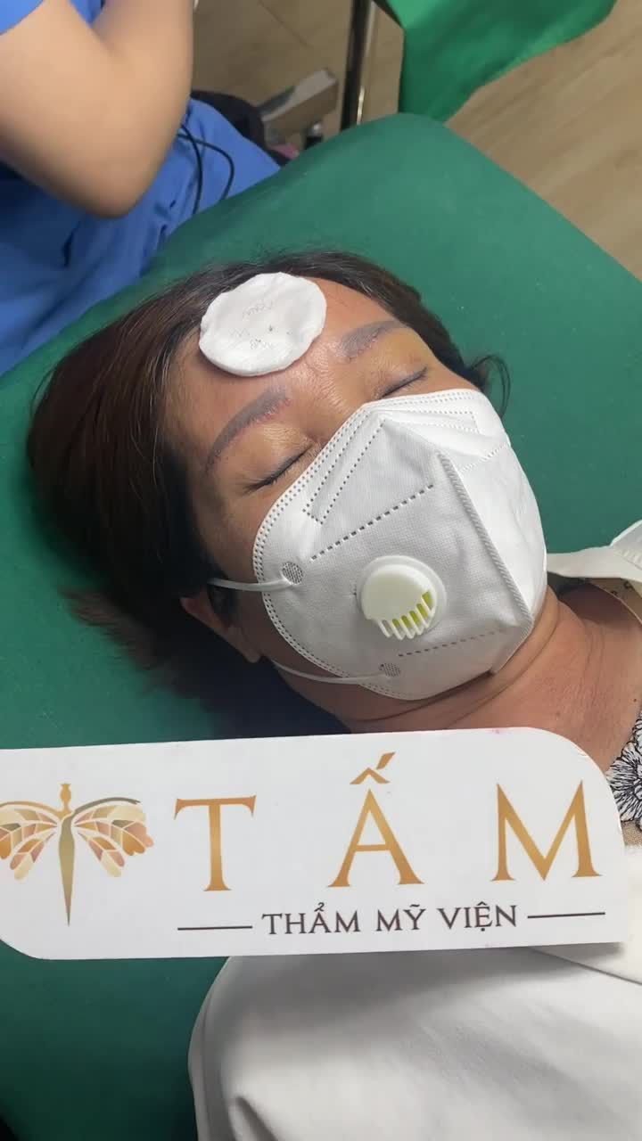 Mời cả nhà theo dõi hình ảnh thực tế của khách hàng cắt chỉ sau 6 ngày làm dịch vụ Nâng cung tại phòng khám nhé!