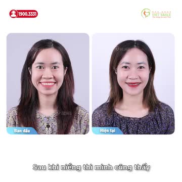 NIỀNG RĂNG GIẢM HÔ KHUÔN MẶT THAY ĐỔI, NỤ CƯỜI TỰ TIN