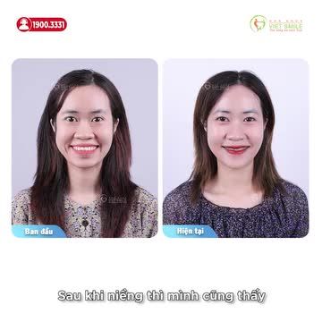 NIỀNG RĂNG GIẢM HÔ KHUÔN MẶT THAY ĐỔI, NỤ CƯỜI TỰ TIN