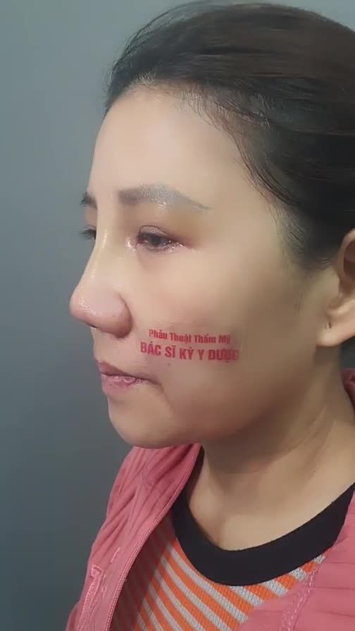 Thay đổi diện mạo nhờ Combo Nâng mũi ALINE Sụn Tai 2 lớp + Cuộn cánh mũi và Treo Cung Mày.