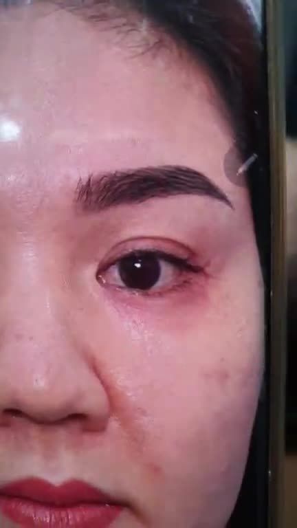 Sau 10 ngày mở góc mắt trong, bác sĩ Kỳ Y Dược đã giúp khách hàng có được đôi mắt đẹp tự nhiên, khắc phục mọi khuyết điểm trước đó.