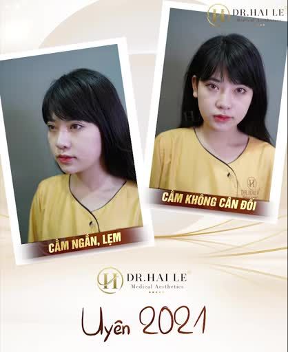 Bạn đang sở hữu cằm ngắn, lẹm, thiếu hài hòa thì tuyệt đối Đừng bỏ qua video này