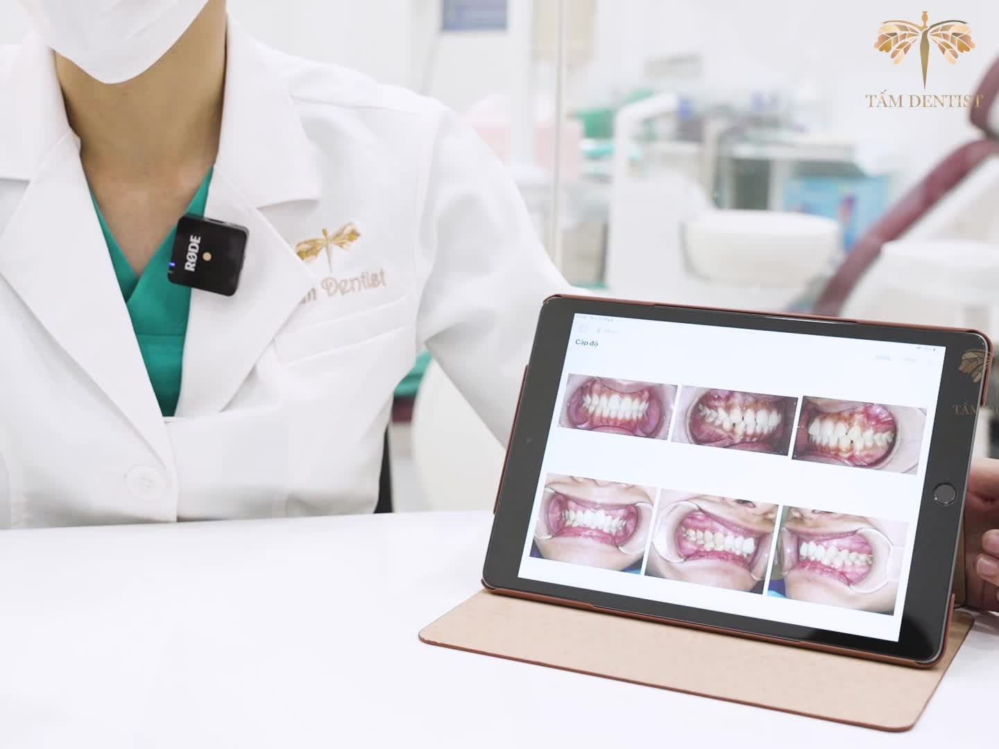 Phân biệt các cấp độ răng khi niềng cùng bác sĩ chuyên khoa RHM tại Hệ thống nha khoa Tấm Dentist