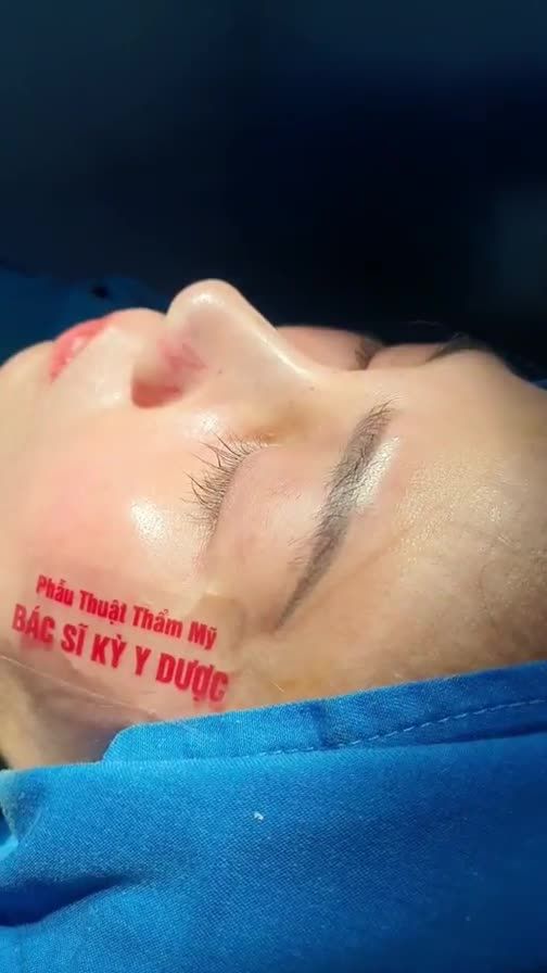 Kết quả Nâng Mũi Aline Bán Cấu Trúc 2 Lớp vừa được chính tay bác sĩ Kỳ Y Dược thực hiện.